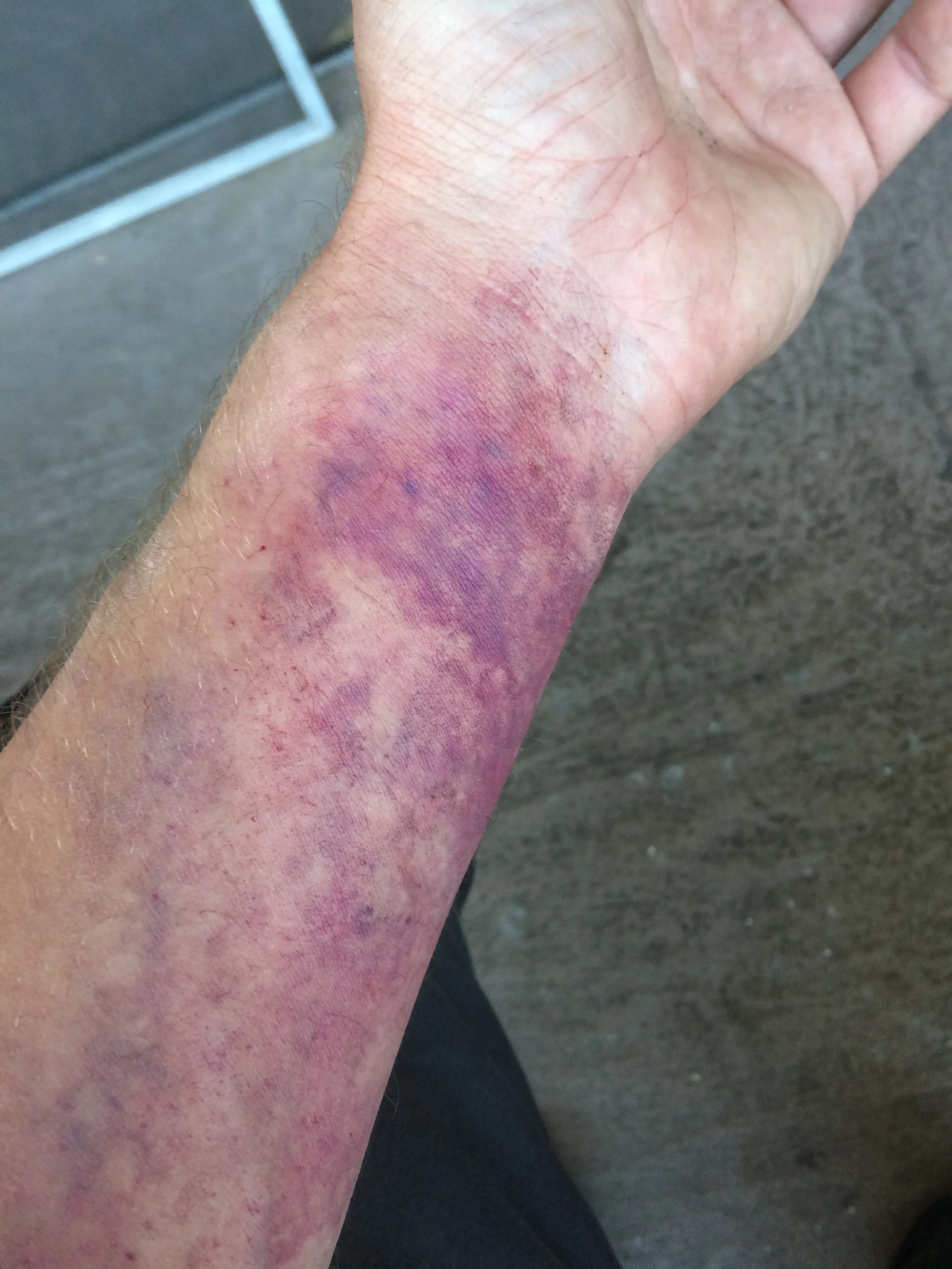 bruising