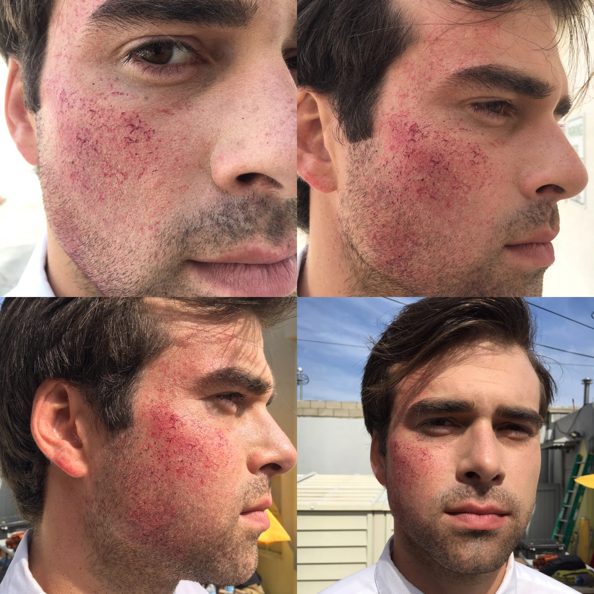 abrasions